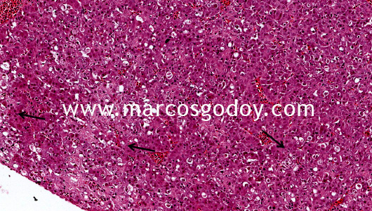 hepatic-necrosis-xi