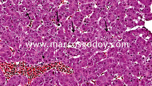 hepatic-necrosis-xiv