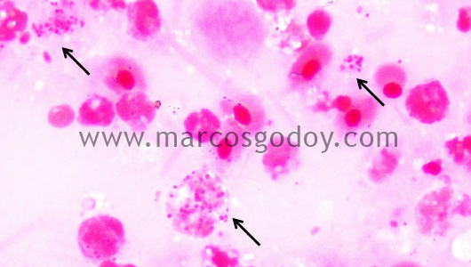 miositis-necrotic-i miositis-necrotic-i