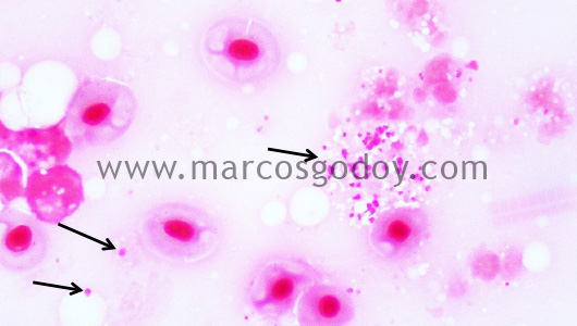 miositis-necrotic-iii miositis-necrotic-iii