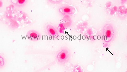 miositis-necrotic-vi miositis-necrotic-vi