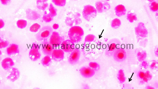miositis-necrotic-vii1 miositis-necrotic-vii1