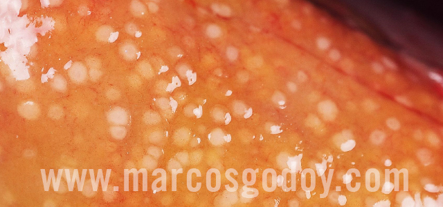 Bacterial kidney diseases - Gross pathology III