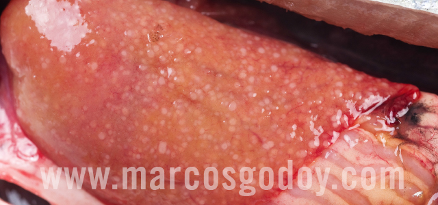 Bacterial kidney diseases - Gross pathology IX