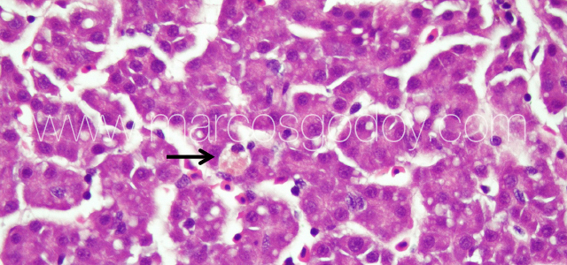 Liver melanomacrophahes center I