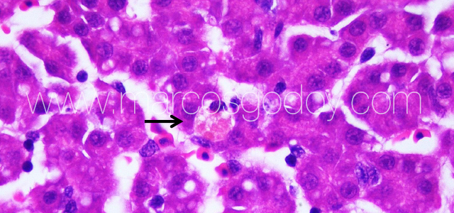 Liver melanomacrophahes center II