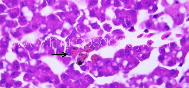 Liver melanomacrophahes center III