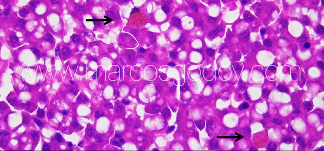 Liver melanomacrophahes center VI