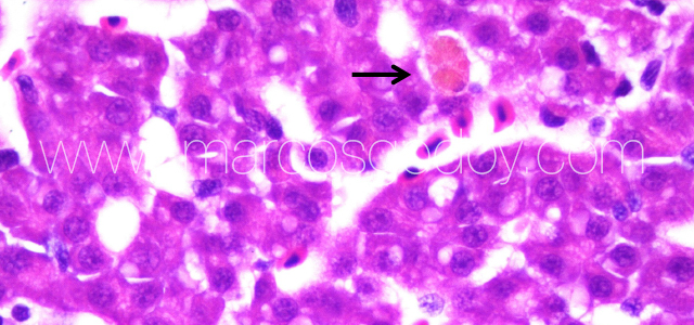 Liver melanomacrophahes center XI