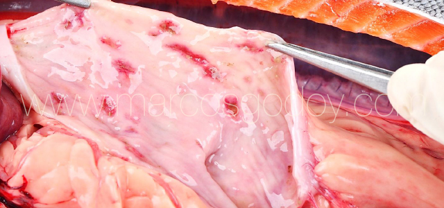Erosive gastritis III