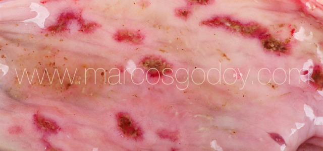 Erosive gastritis IV