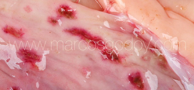 Erosive gastritis V