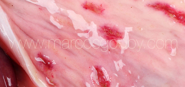 Erosive gastritis VII