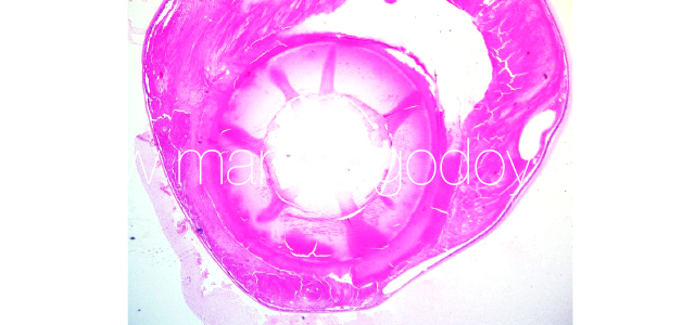 Lens deformation IV