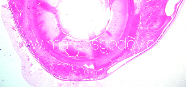 Lens deformation V
