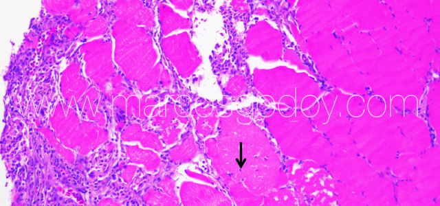 Exophiala muscle IV