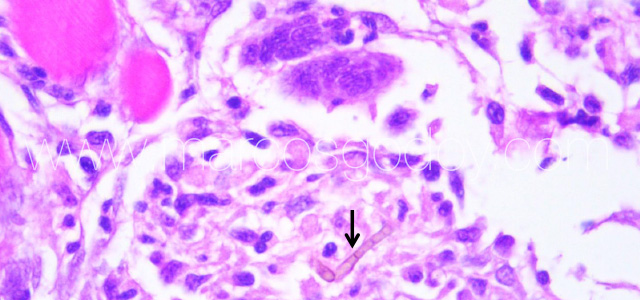 Exophiala muscle IX