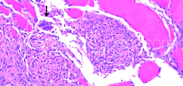 Exophiala muscle VI