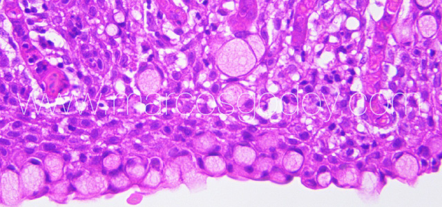 PGD HistologyXI