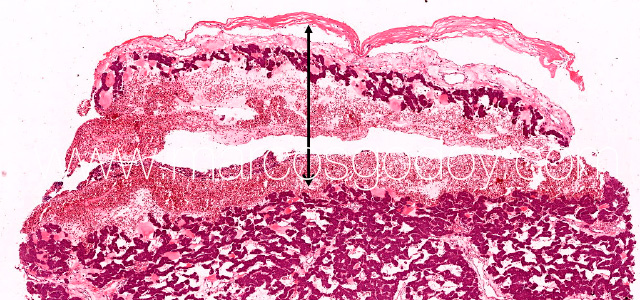 Hepatic rupture I