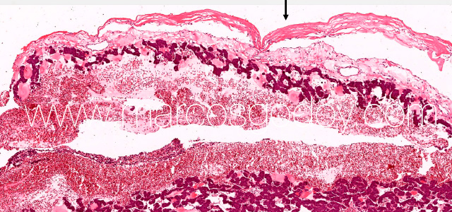 Hepatic rupture II