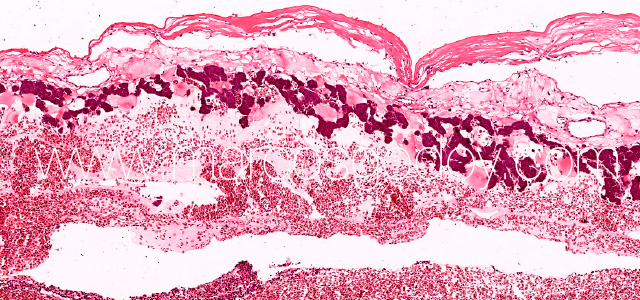 Hepatic rupture III