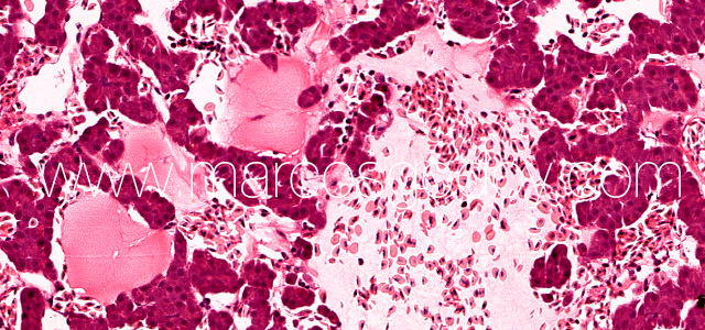 Hepatic rupture IX