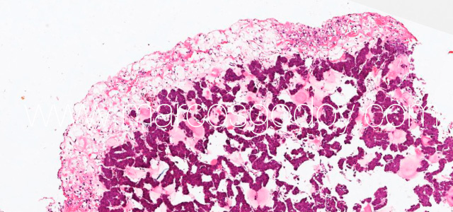 Hepatic rupture VI