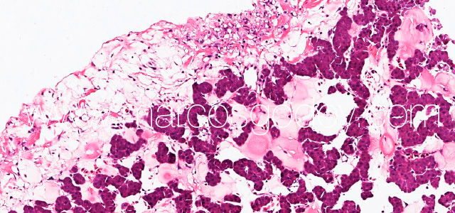 Hepatic rupture VII