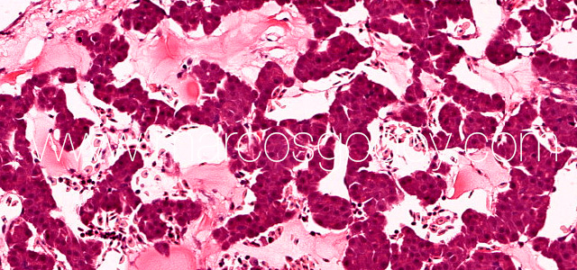Hepatic rupture X
