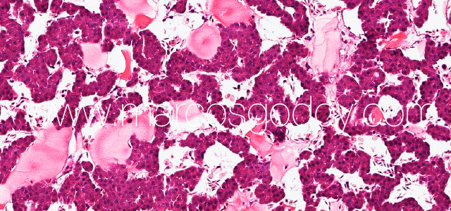 Hepatic rupture XI