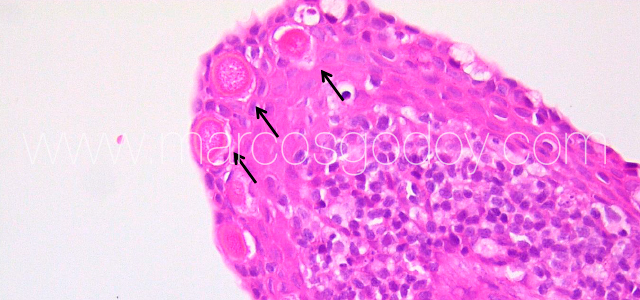 Epiteliocystis Coho II