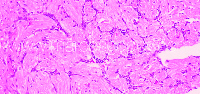 Myocarditis Flavo I