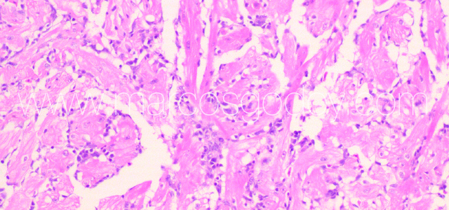 Myocarditis Flavo III