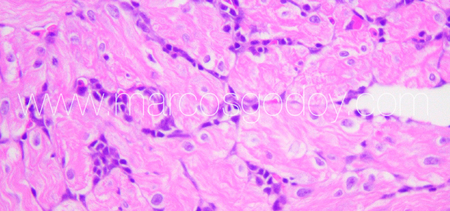 Myocarditis Flavo V