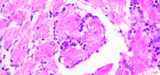 Myocarditis Flavo VIII
