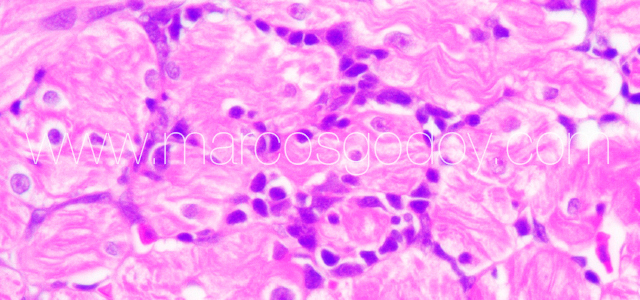 Myocarditis Flavo X