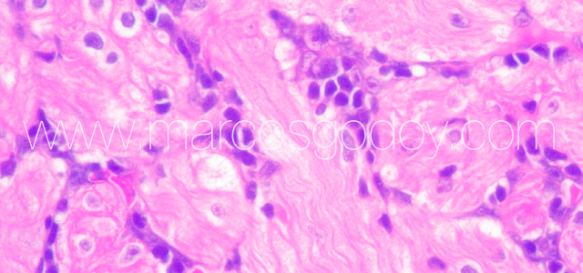 Myocarditis Flavo XI