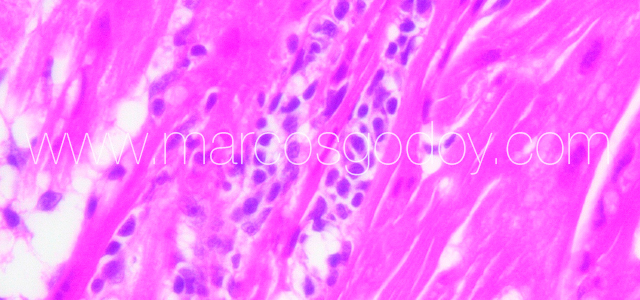 Myocarditis Flavo XII