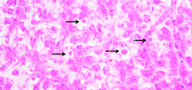 Hepatic hialinization II