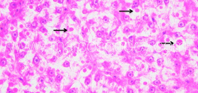 Hepatic hialinization III