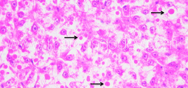 Hepatic hialinization IV