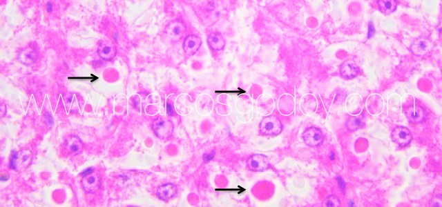 Hepatic hialinization IX
