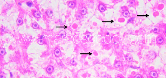 Hepatic hialinization VII