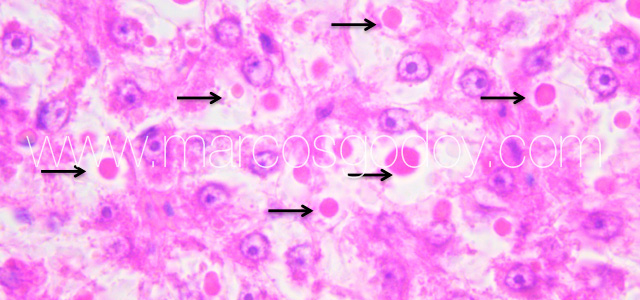 Hepatic hialinization VIII