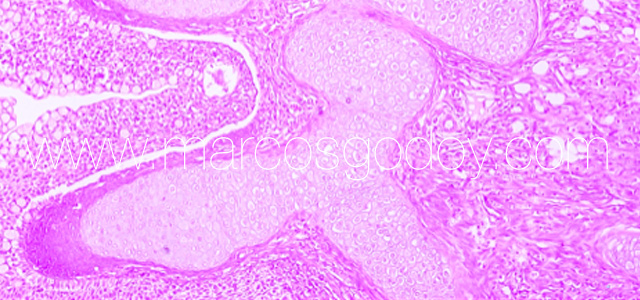 Condroplasia Condroplasia VI