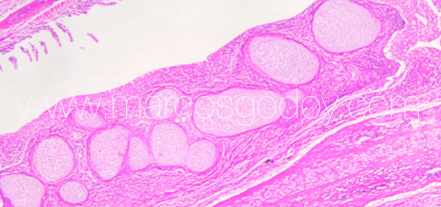 Condroplasia Condroplasia VII