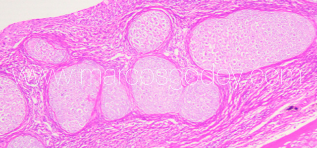 Condroplasia IX