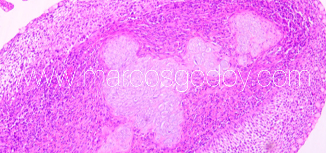 Condroplasia XVI