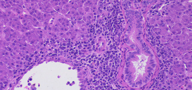 Colangitis 4